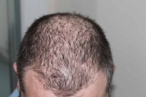 hair transplant clinic