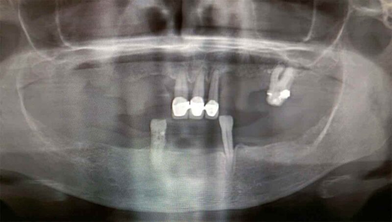 fog implantátum